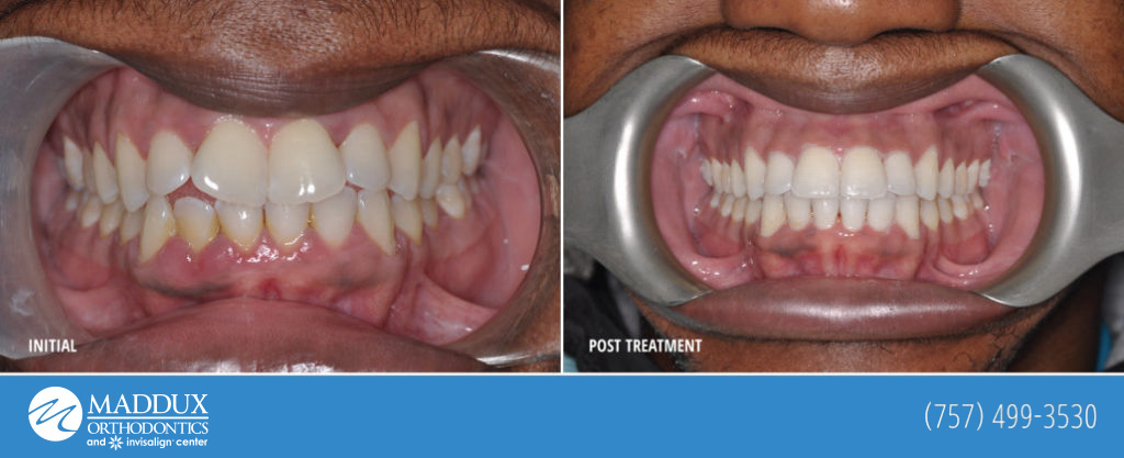Maddux orthodontics before and after patient success