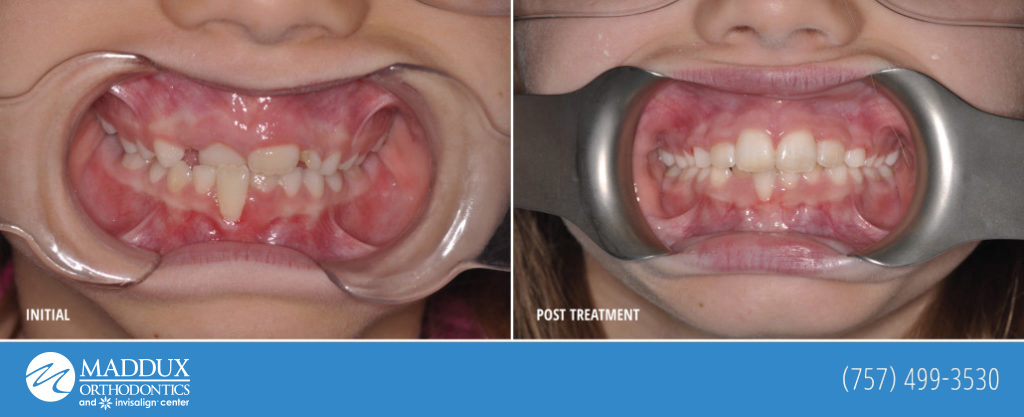 Maddux orthodontics before and after