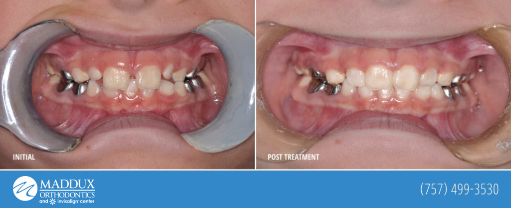 Maddux orthodontics before and after