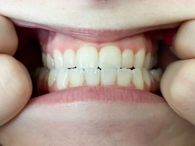 Maddux Orthodontics center view of teeth Virtual Smile Assessment