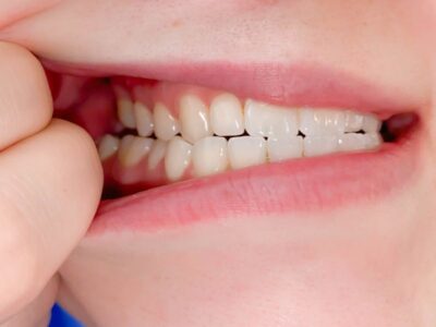 Maddux Orthodontics side view teeth Virtual Smile Assessment