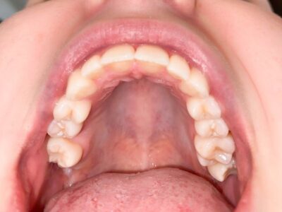 Maddux Orthodontics lower teeth Virtual Smile Assessment