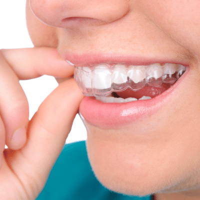 Best retainer after braces: which one is best for you? 3 A close up of a woman's mouth while putting retainer in, representing best retainer after braces